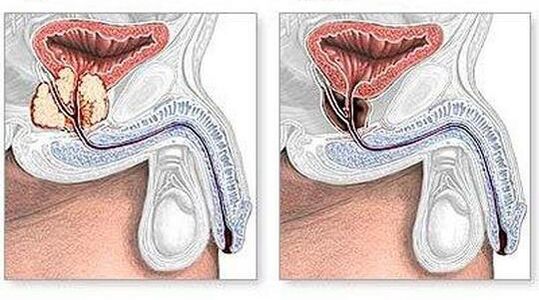 Vor und nach der Behandlung von chirurgisch chronischer Prostatitis