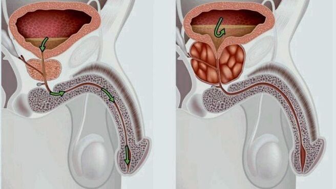 gesunde und entzündete Prostata mit Prostatitis