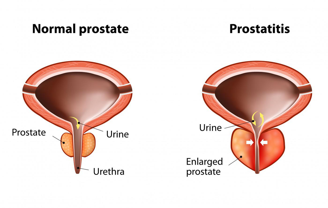 Normale Prostata eines gesunden Mannes und Entzündung der Prostata mit Prostatitis.