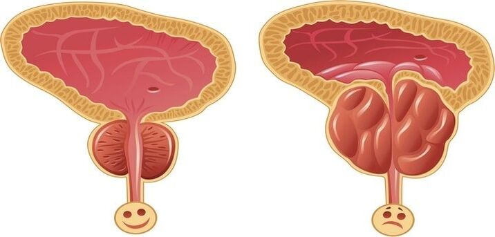 gesunde und entzündete Prostata